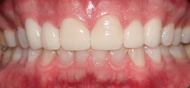 Front three teeth healthy and whitened after cosmetic dentistry