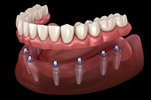 Implant dentures in Cary