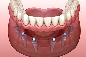 six dental implants supporting an implant denture 
