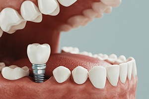 Diagram showing how dental implants in Cary work