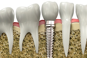 Diagram showing dental implants in Cary during osseointegration