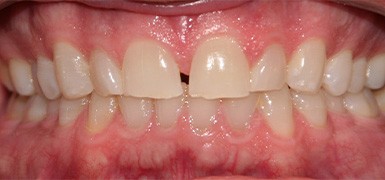 Front three teeth with severe discoloration and yellowing