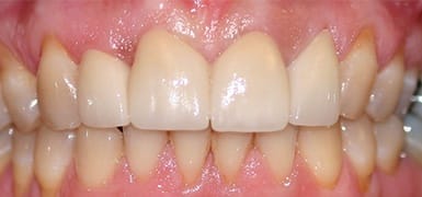 Closed gap between front teeth after Invisalign