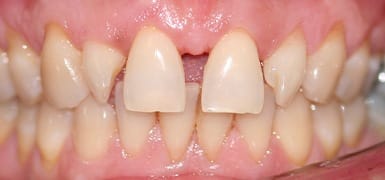 Gap between front two teeth before Invisalign