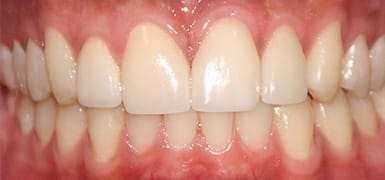 Closed gap between top front teeth after Invisalign