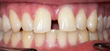 Large gap between top front teeth before Invisalign