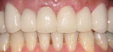 Perfected smile after cosmetic dentistry