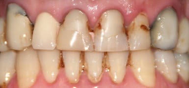 Decayed and discolored teeth before cosmetic dentistry