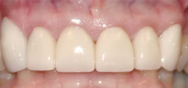 Brilliant white top teeth after teeth whitening