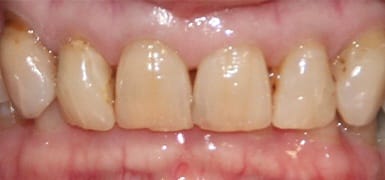 Yellowed top teeth before teeth whitening