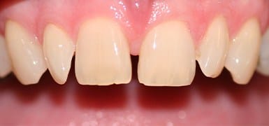 Yellowed and unevenly spaced teeth before porcelain veneers