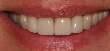 Front three teeth healthy and whitened after cosmetic dentistry