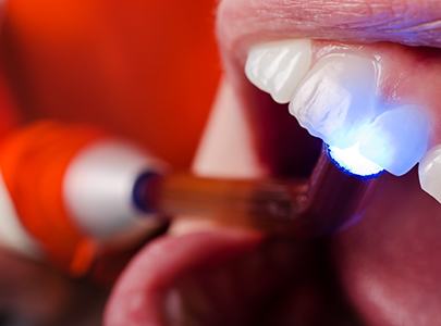 Patient receiving dental bonding treatment