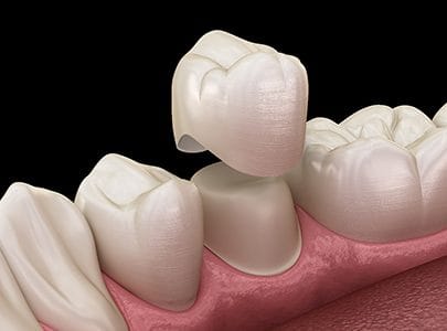 Illustration of dental crown in Cary being placed on tooth