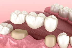 Illustration of traditional dental bridge in Cary