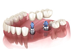 Illustration of implant bridge in Cary