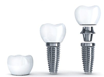 Diagram showing a series of dental implants in Cary