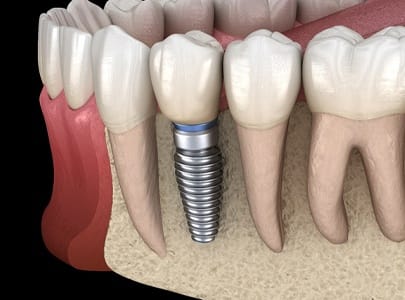 Diagram of an integrated dental implant in Cary