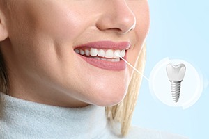patient mouth with dental implant illustration