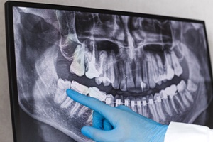 Wisdom Tooth X-ray cost of tooth extractions in Cary