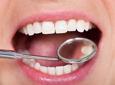 close-up of a person’s mouth with a dental mirror inside of it 