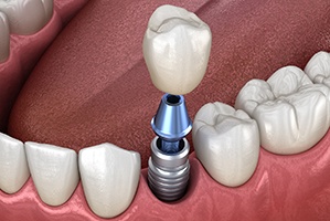 single dental implant supporting a dental crown 