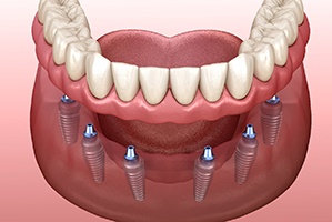 six dental implants supporting an implant denture