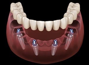 Animated all-on-4 dental implant denture
