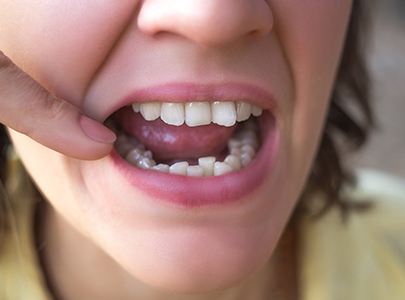 Closeup of crowded teeth