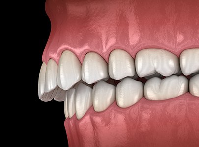 Digital illustration of an overbite