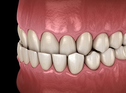 Digital illustration of an underbite