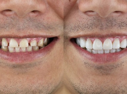 Before and after of a smile makeover