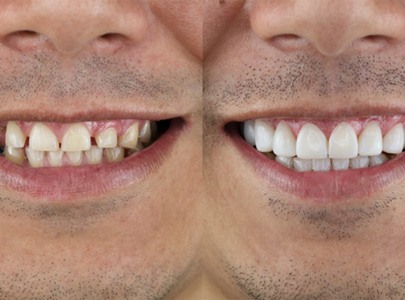 Before and after of a smile makeover