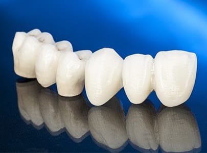 Tooth-colored dental bridge prior to placement