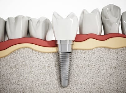 Animated dental implant