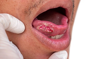 A closeup of a man showing signs of oral cancer