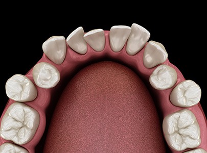 Model of crowded teeth