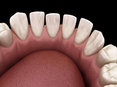 Model of tooth gaps