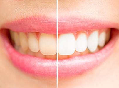before and after picture of teeth whitening in Cary