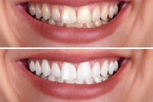 close up of teeth before and after whitening