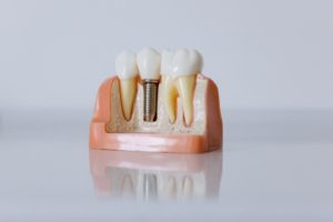 Model of a single dental implant