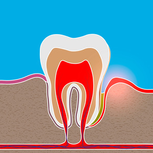 Illustration of gum pocket caused by gum disease